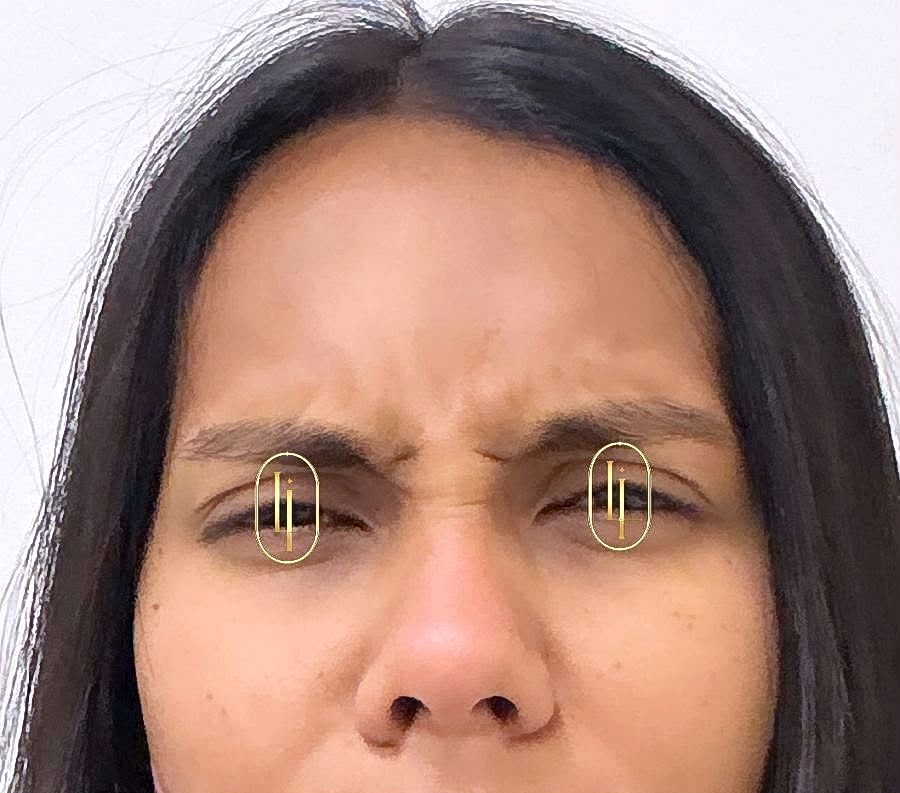 Antes do botox na glabela na Idôle