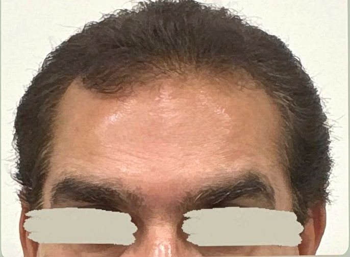 Depois do botox na testa na Idôle