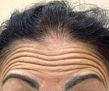 Antes do botox na testa na Idôle