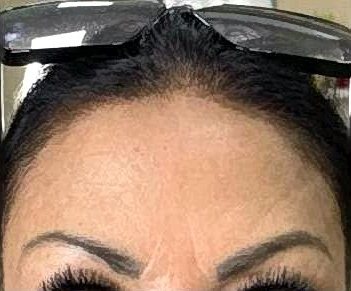 Depois do botox na testa na Idôle