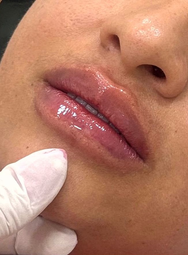 Depois do preenchimento labial na Idôle