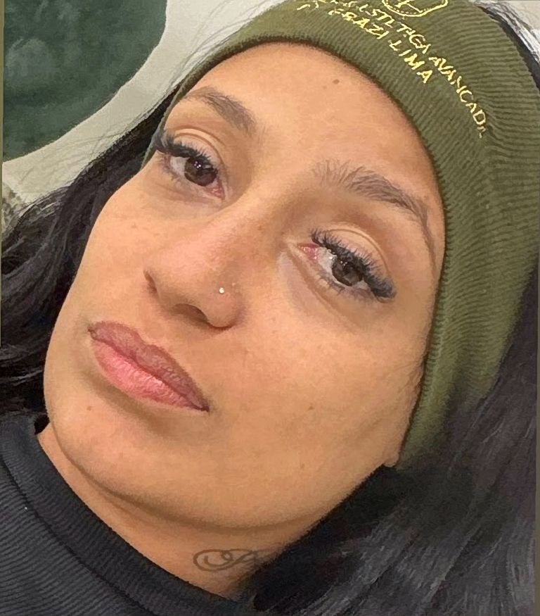 Antes do preenchimento labial na Idôle