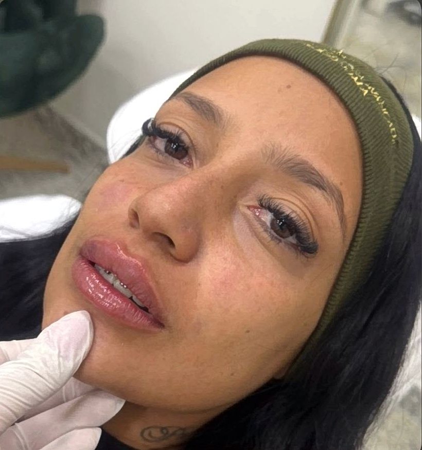 Depois do preenchimento labial na Idôle
