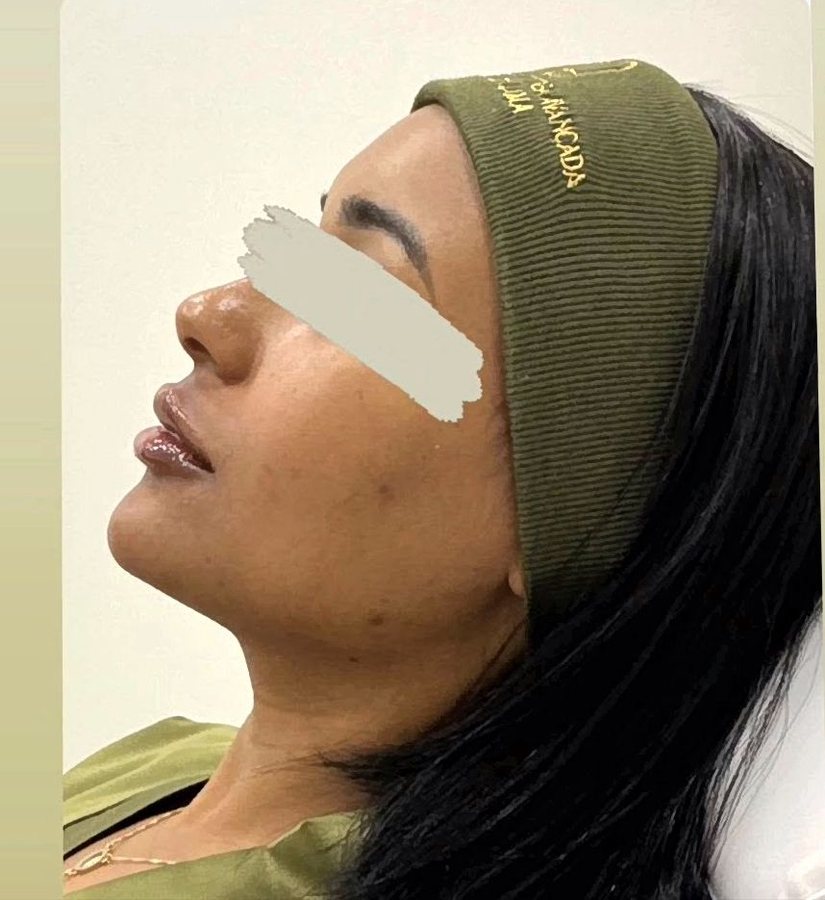 Depois do preenchimento labial na Idôle